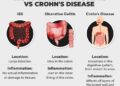 Crohn's Disease: Current Management and Prospective Therapies