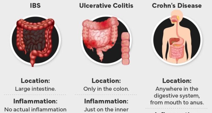 Crohn's Disease: Current Management and Prospective Therapies