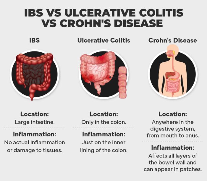 Crohn's Disease: Current Management and Prospective Therapies Crohn's Disease: Current Management and Prospective Therapies